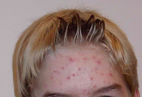 Acne Remedy Do You Prefer High Tech Choices Or Residence Remedy With No Side Effects It Is Your Cal best adult acne scars medication treatmen cure laser product Acne Remedy Do You Prefer High Tech Choices Or Residence Remedy With No Side Effects It Is Your Cal