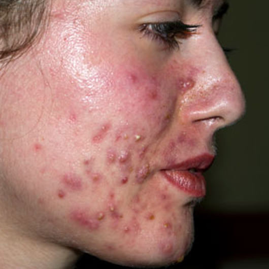 Medical Definition of Acne vulgaris - MedicineNet